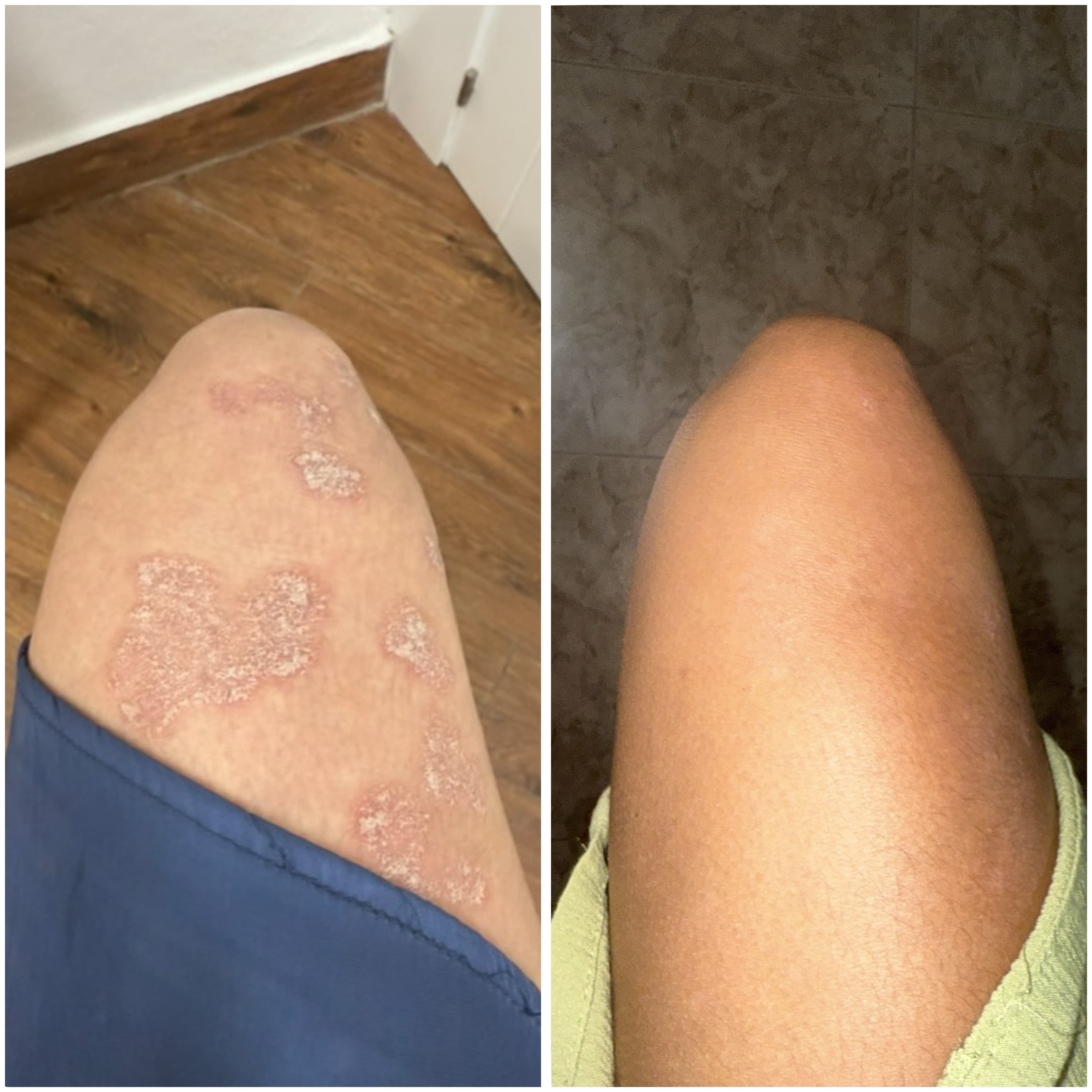 Restorative CBD Cream for Dry, Flaky and Psoriasis-prone skin
