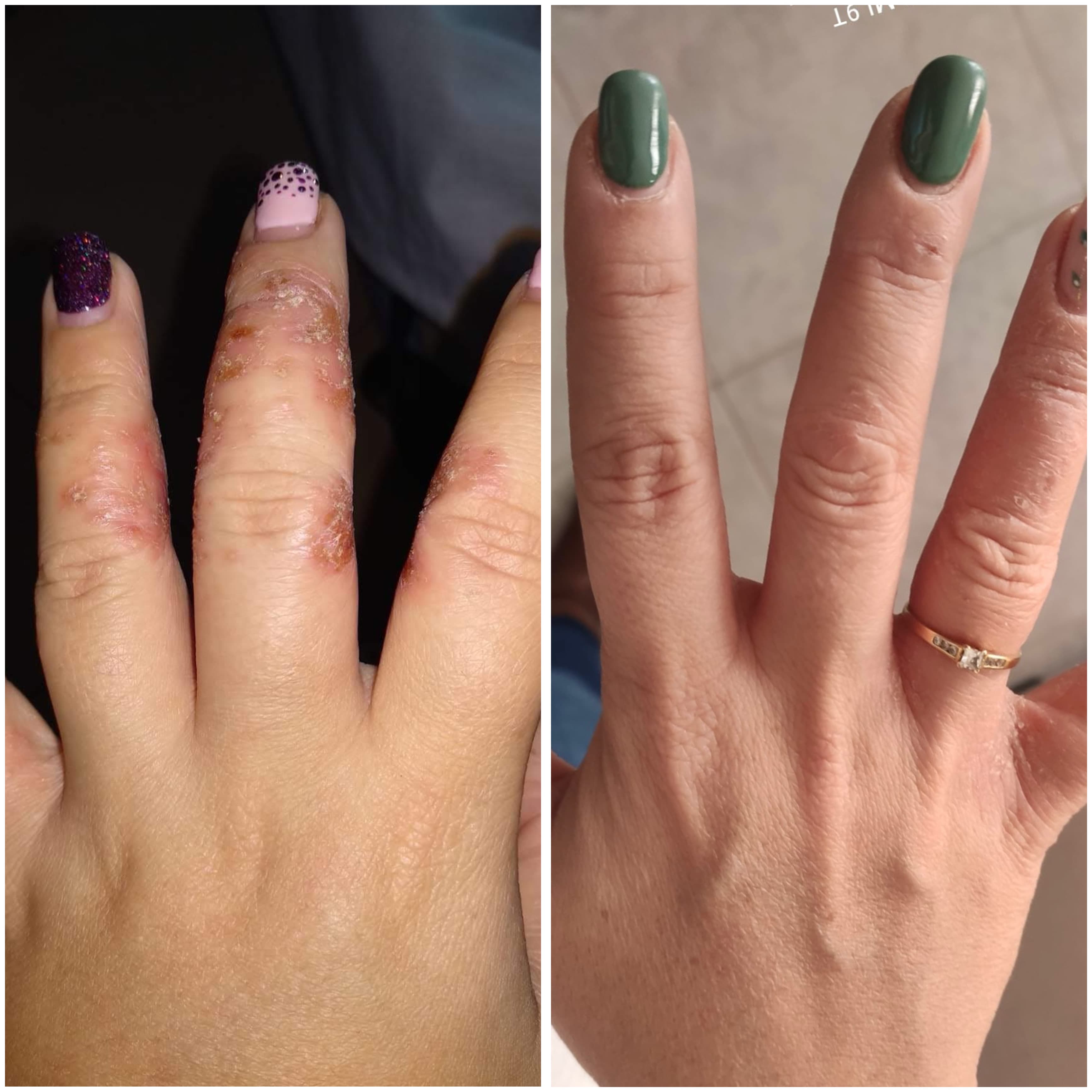 Restorative CBD Cream for Dry, Flaky and Psoriasis-prone skin