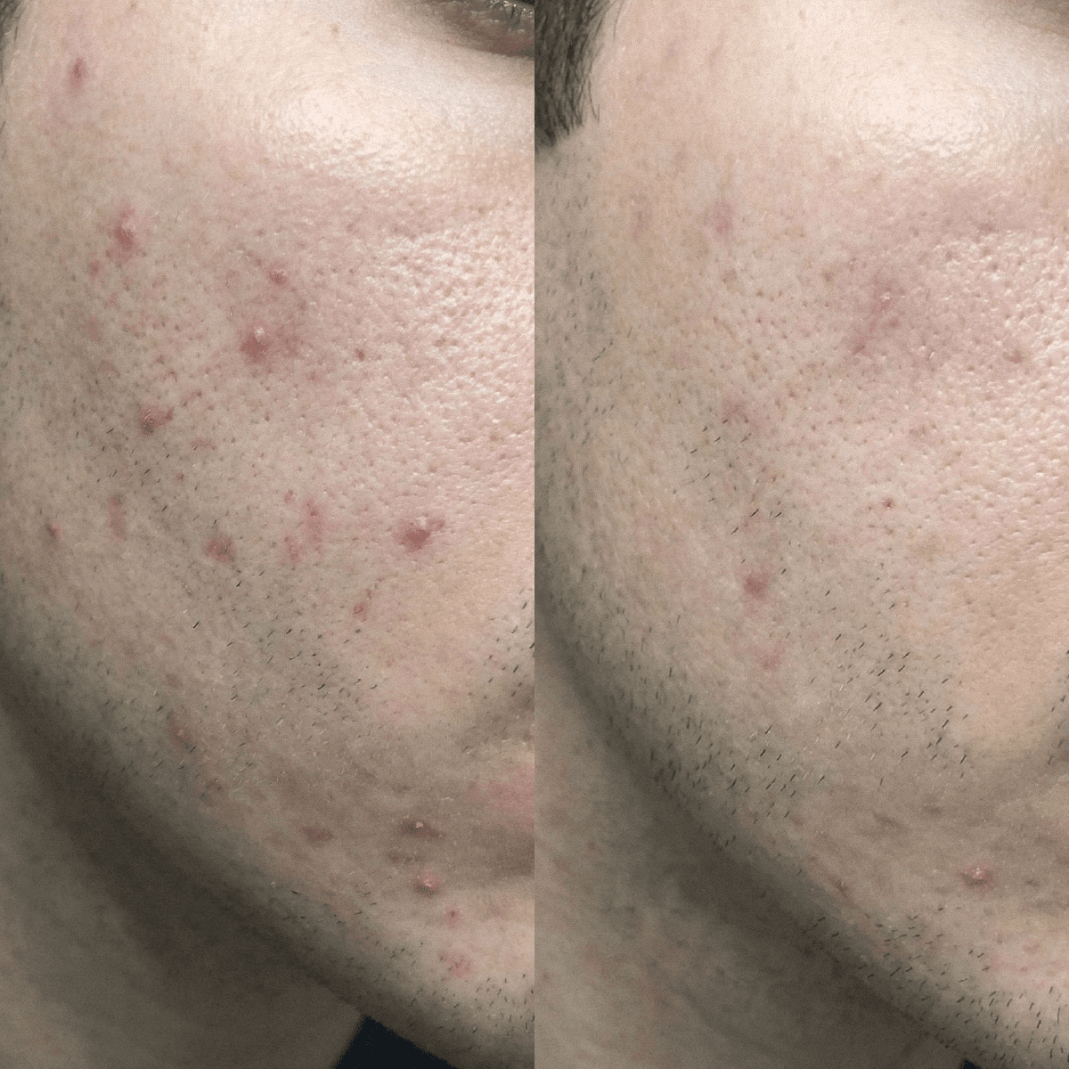 Blemish Purity CBD Cream for Acne-prone skin