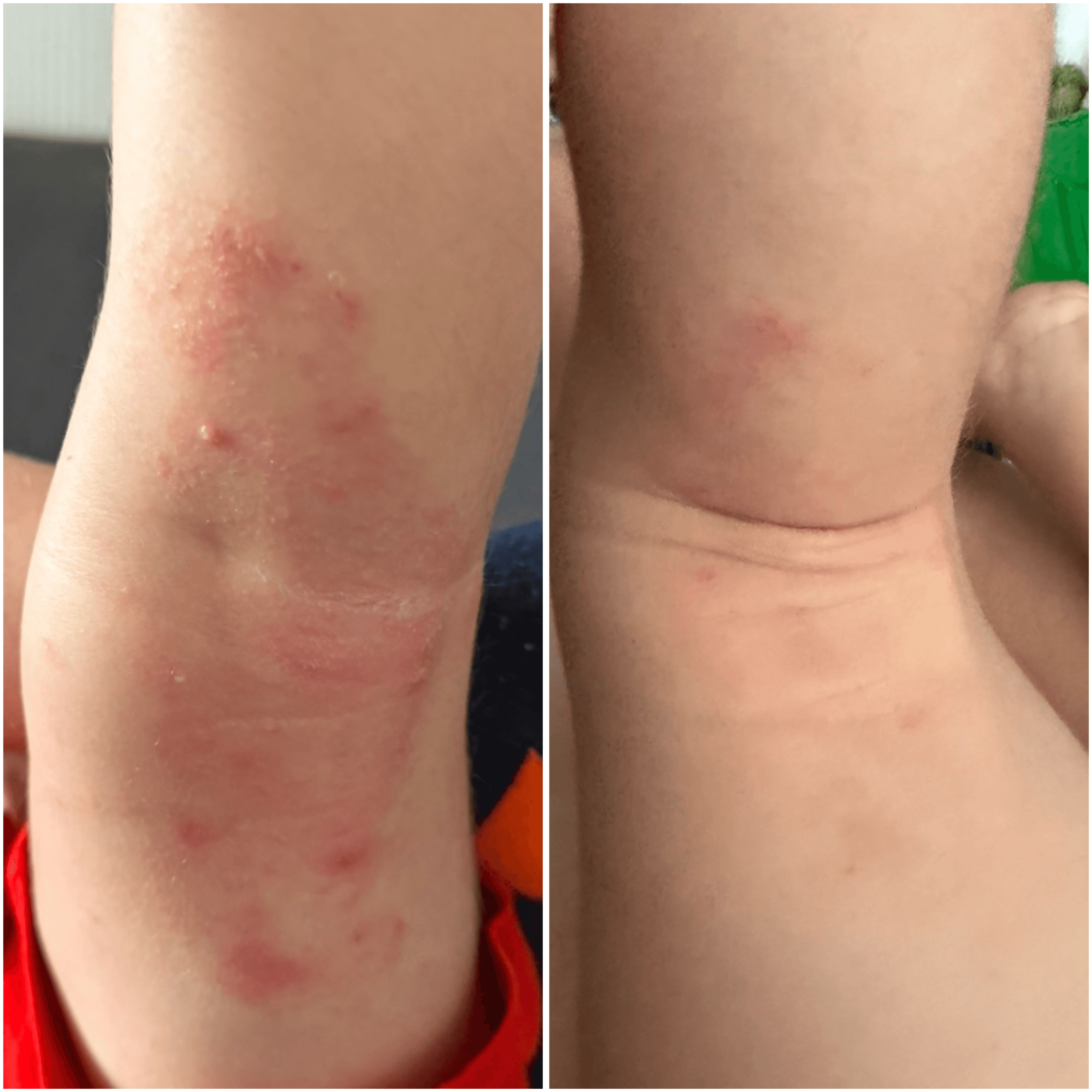 CBD Cream for dry, atopic and eczema-prone skin