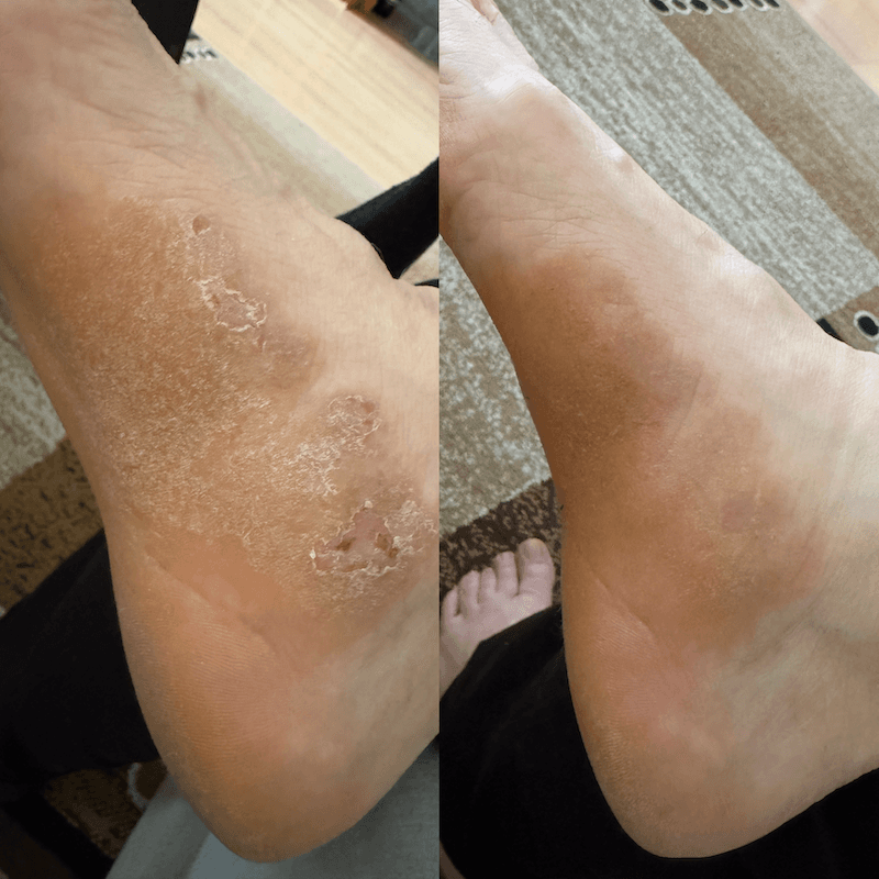 CBD Cream for dry, atopic and eczema-prone skin