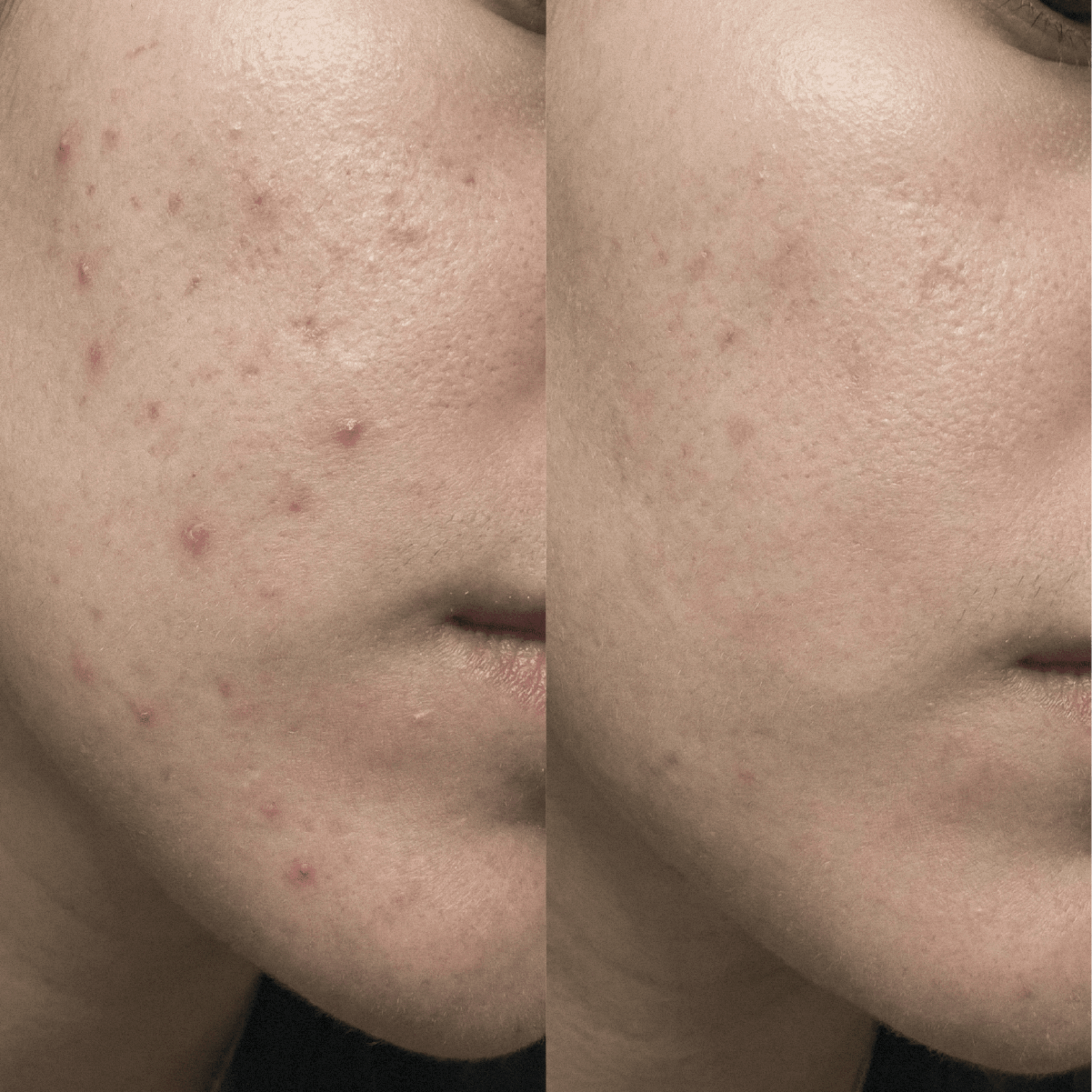 Blemish Purity CBD Cream for Acne-prone skin