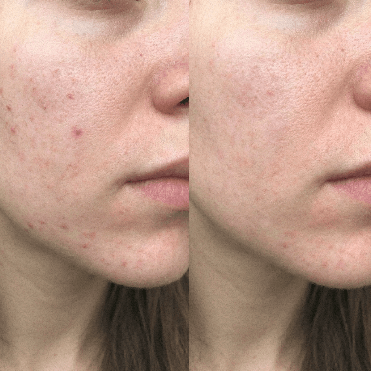 Blemish Purity CBD Cream for Acne-prone skin